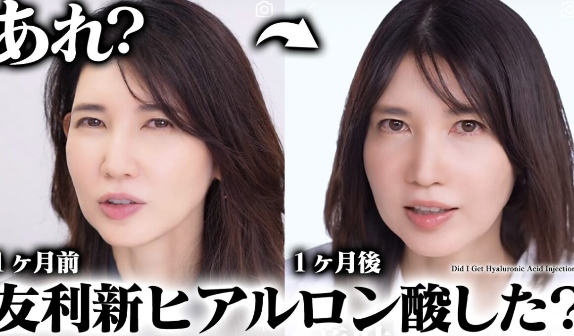 【ヒアルロン酸入れた？】問い合わせ多数。友利新の１ヶ月の変化