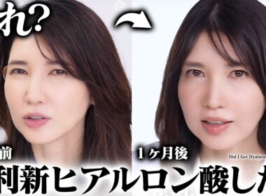 【ヒアルロン酸入れた？】問い合わせ多数。友利新の１ヶ月の変化