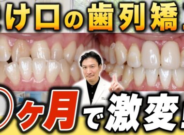 症例紹介！〜受け口編〜【歯列矯正を検討中の方必見！】